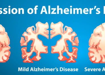 alzheimer