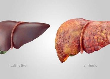 Fatty liver