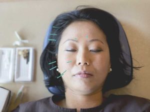 Acupuncture for Migraines