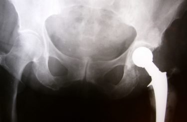 X-ray image of hip implant