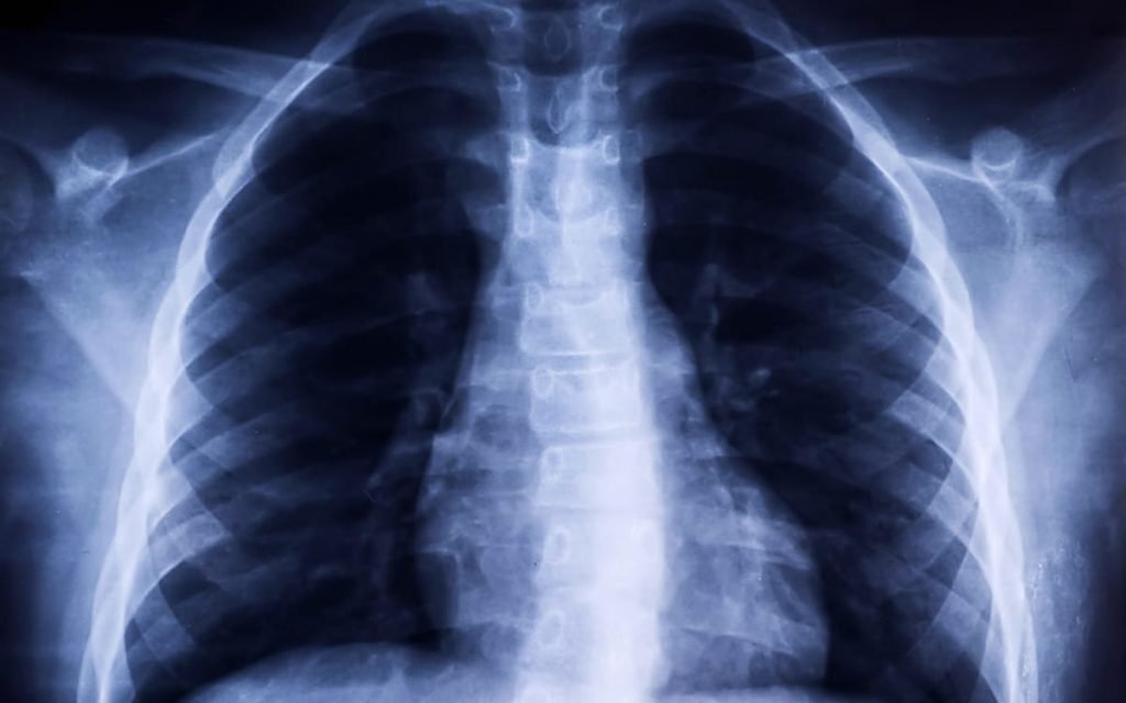 new-jersey-mass-torts-defective-devices-chest-xray