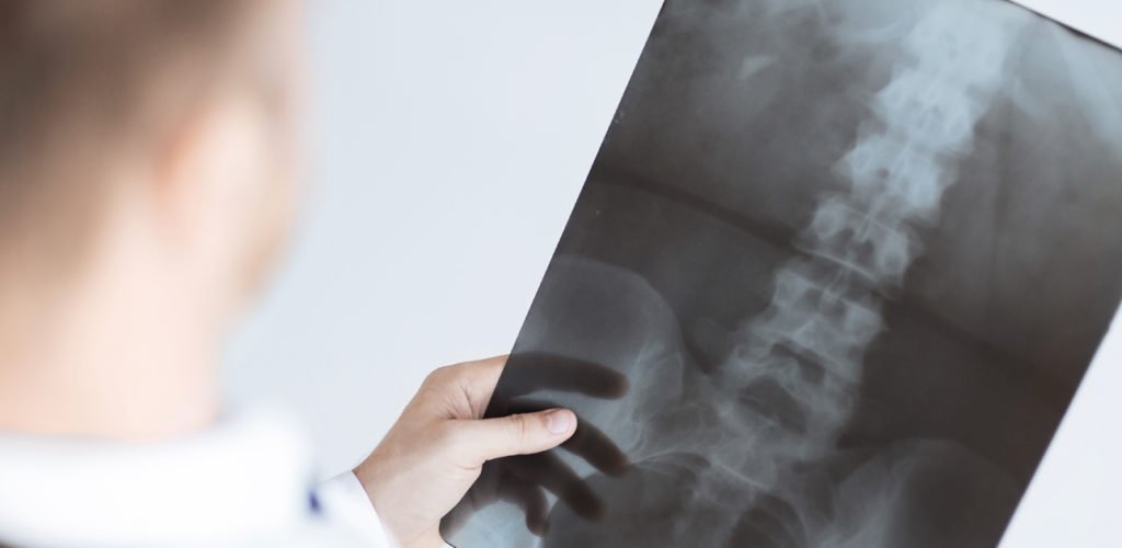 spine injury car accident lawyer